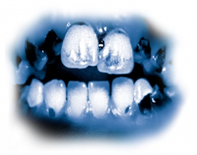 Токсические ингредиенты в составе метамфетамина вызывают гнойное поражение зубов, известное как «метамфетаминовый рот». Зубы становятся чёрными, с пятнами, гниют, из-за чего их приходится просто вырывать. Зубы и дёсны разрушаются изнутри, а корни полностью сгнивают.